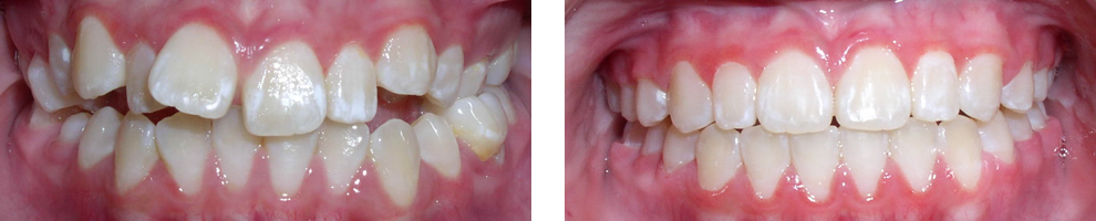 Case 1: Class II crowding, treated with non-extraction