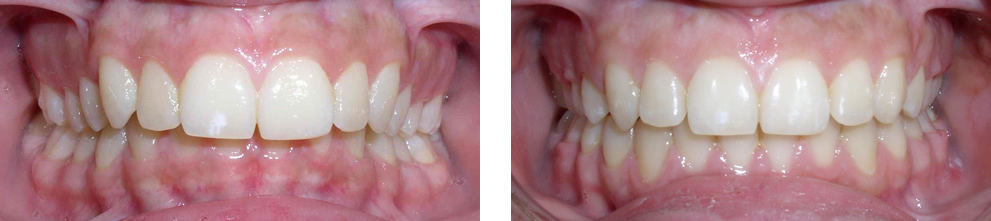 Case 2:  Class II deep overbite, treated with non-extraction