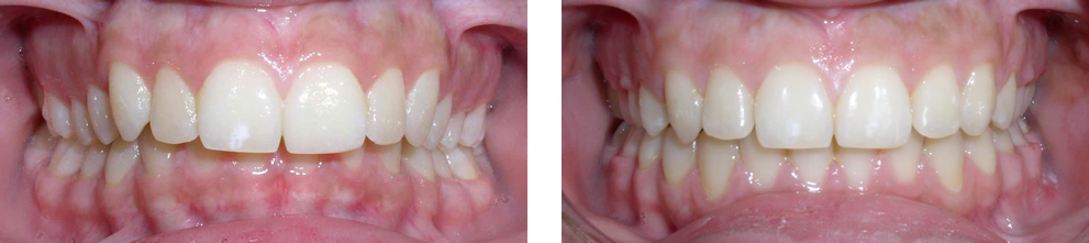 Case 2: Class II deep overbite, treated with non-extraction