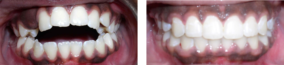 Case 3: Anterior openbite with tongue thrusting habit, treated with non-extraction