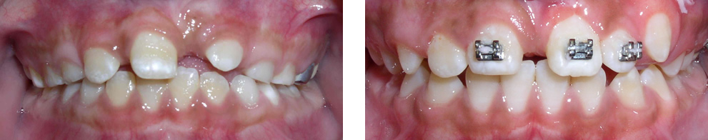 Case 4:  Class I with impacted upper left central incisors, treated with phase I orthodontic treatment and surgical exposure to bring down impacted tooth