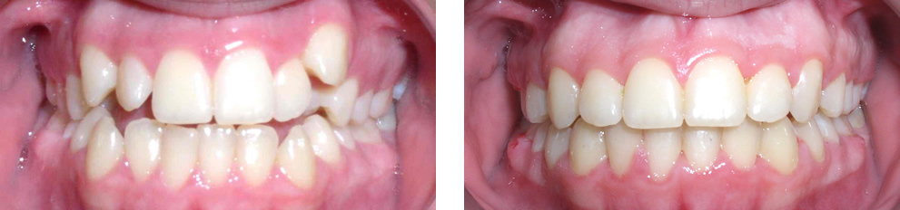 Case 5: Class I crowding, treated with extraction of 4 premolars
