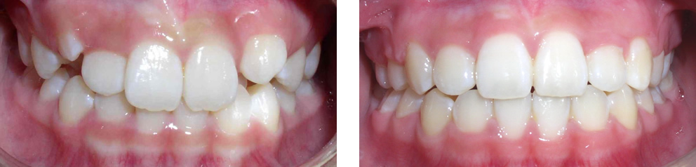 Case 6: Class I crowding with missing two lower incisors, treated with extraction of two upper premolars