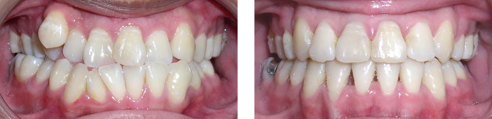 Case 7:  Class III crowding, treated with extraction of 4 premolars