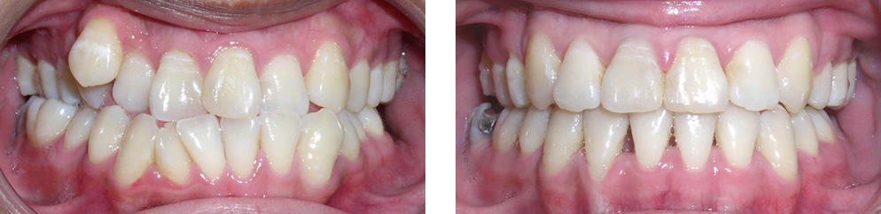 Case 7: Class III crowding, treated with extraction of 4 premolars